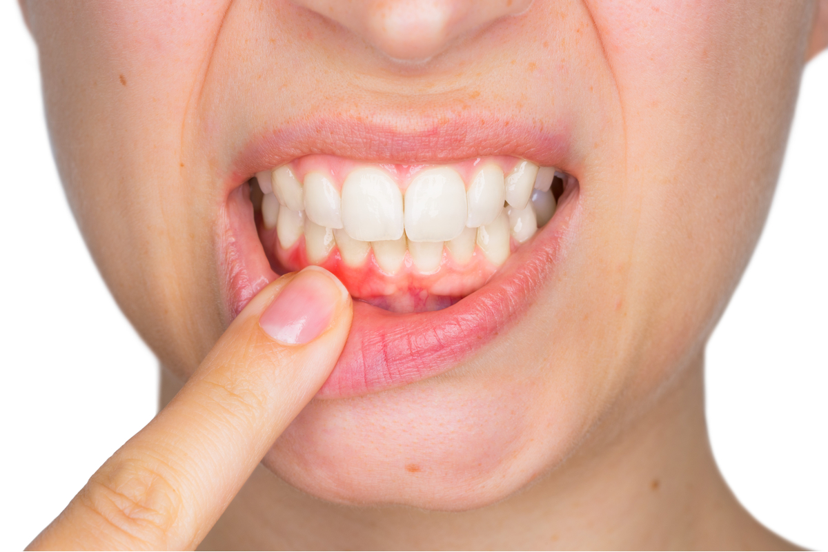 Sanatatea incepe in gura, sau mai bine zis cu spalatul pe dinti. gingia-si-probleme-gingivale